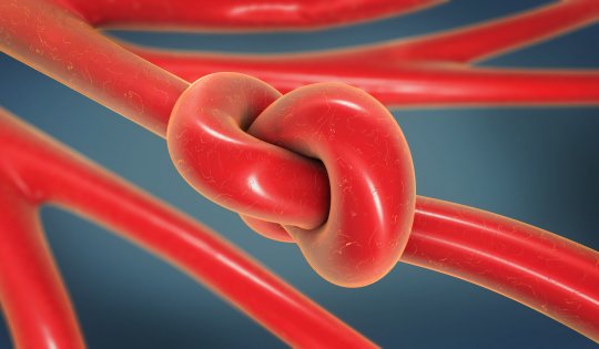 3d illustration of a knot in an artery being constricted and narrowed called arteriosclerosis